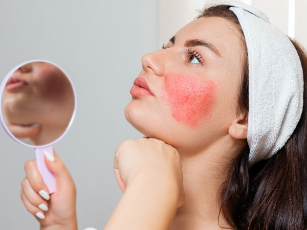 Rosacea megszelídítése